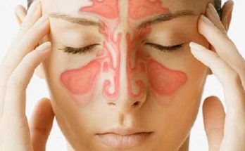 8 Effective Natural Cures For Sinus Infection