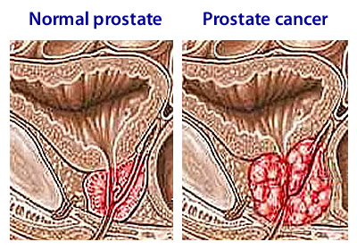 prostate cancer (2)